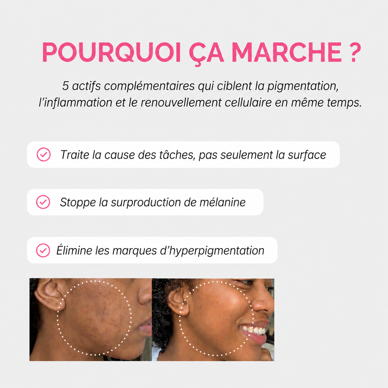 Kit hyperpigmentation